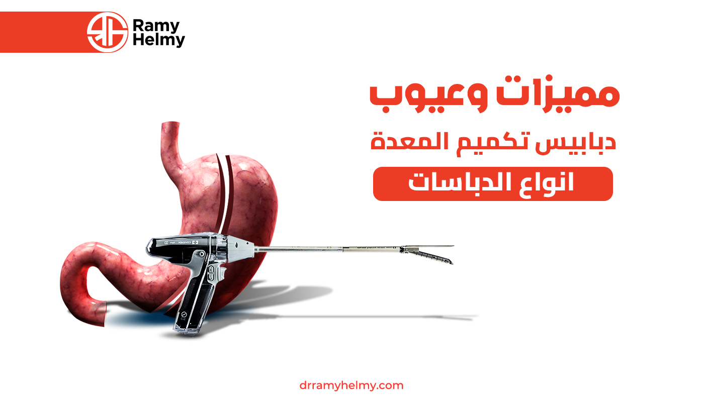 مميزات وعيوب دبابيس تكميم المعدة