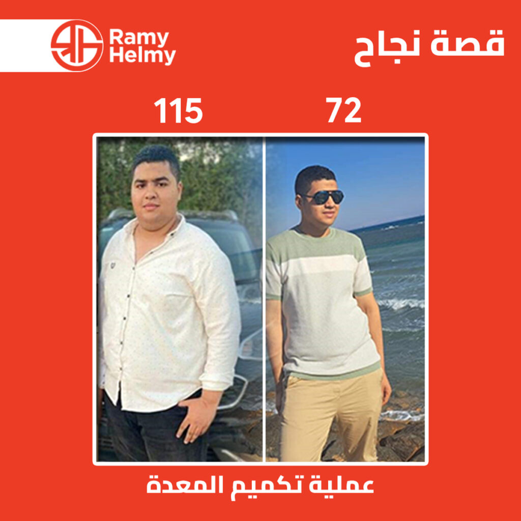 نتائج عملية التكميم في مركز دكتو رامي حلمي