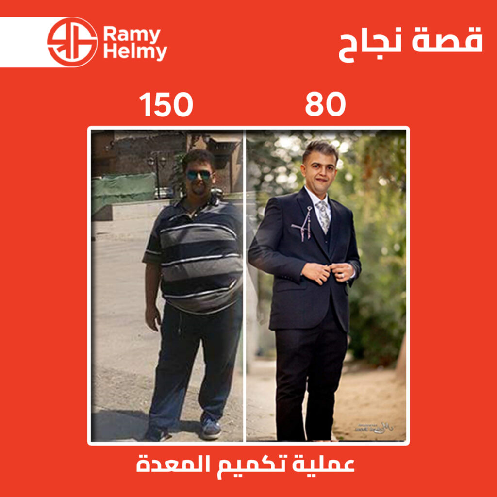 من نتائج عملية تكميم المعدة مع رامي حلمي