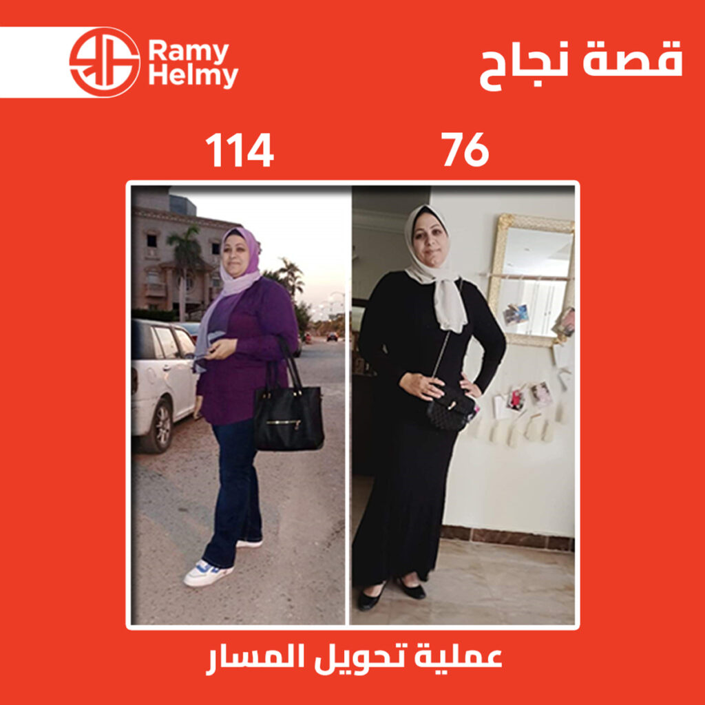 نتائج عملية تحويل المسار مع دكتور رامي حلمي