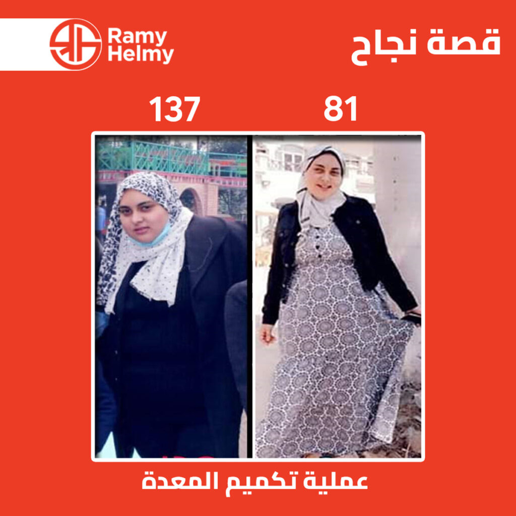 من نتائج التكميم مع دكتور رامي حلمي