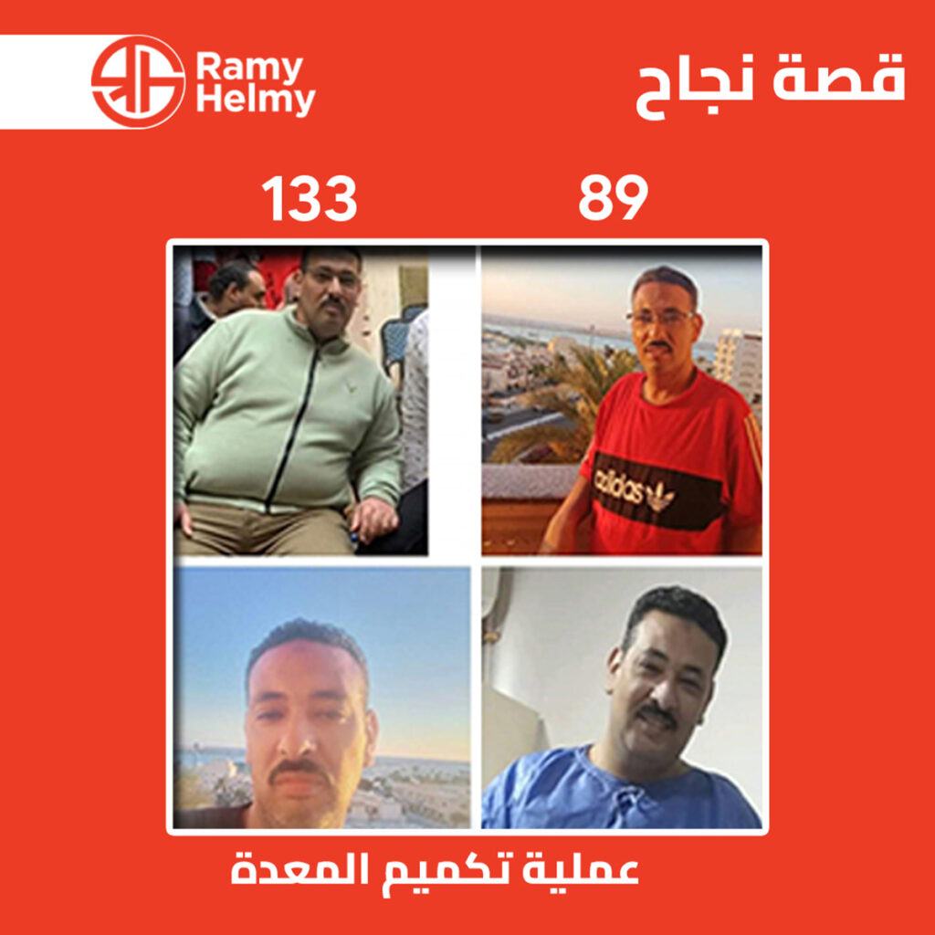 عملية تكميم المعدة