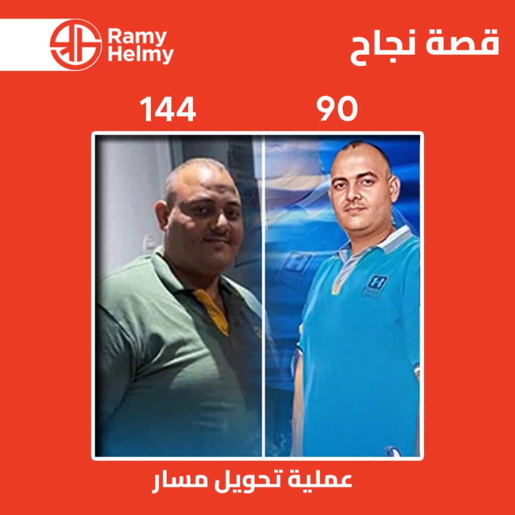 عملية تحويل مسار المعدة