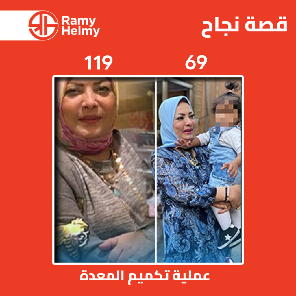 تجربتي مع تكميم المعدة مع الدكتور رامي حلمي