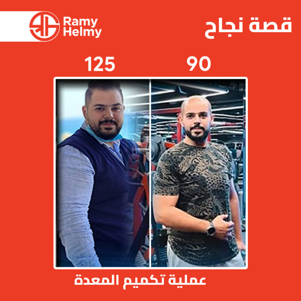 من نتائج تكميم المعدة في مركز دكتور رامي حلمي