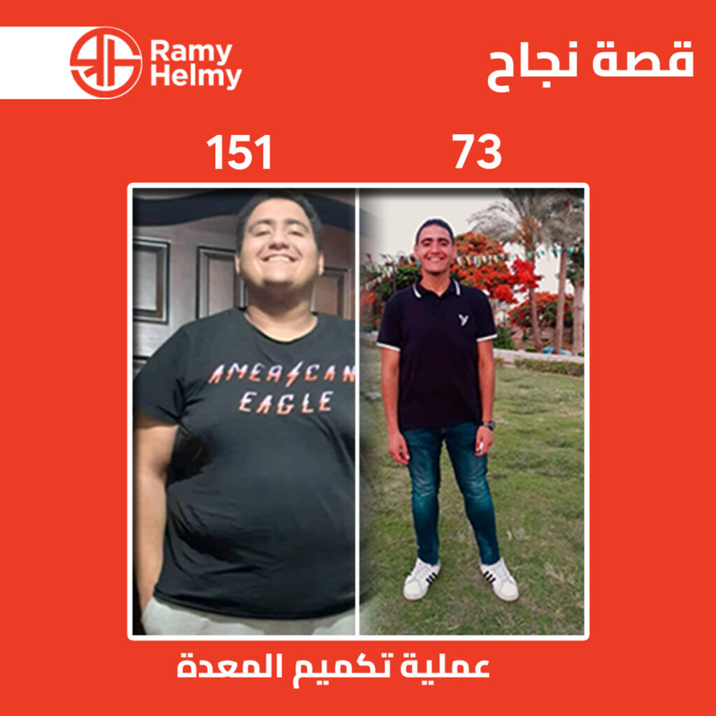 قبل وبعد عملية تكميم المعدة