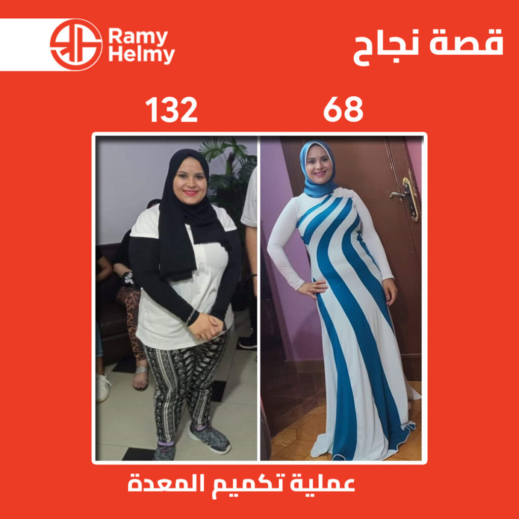 من نتائج عملية تكميم المعدة في مركز رامي حلمي