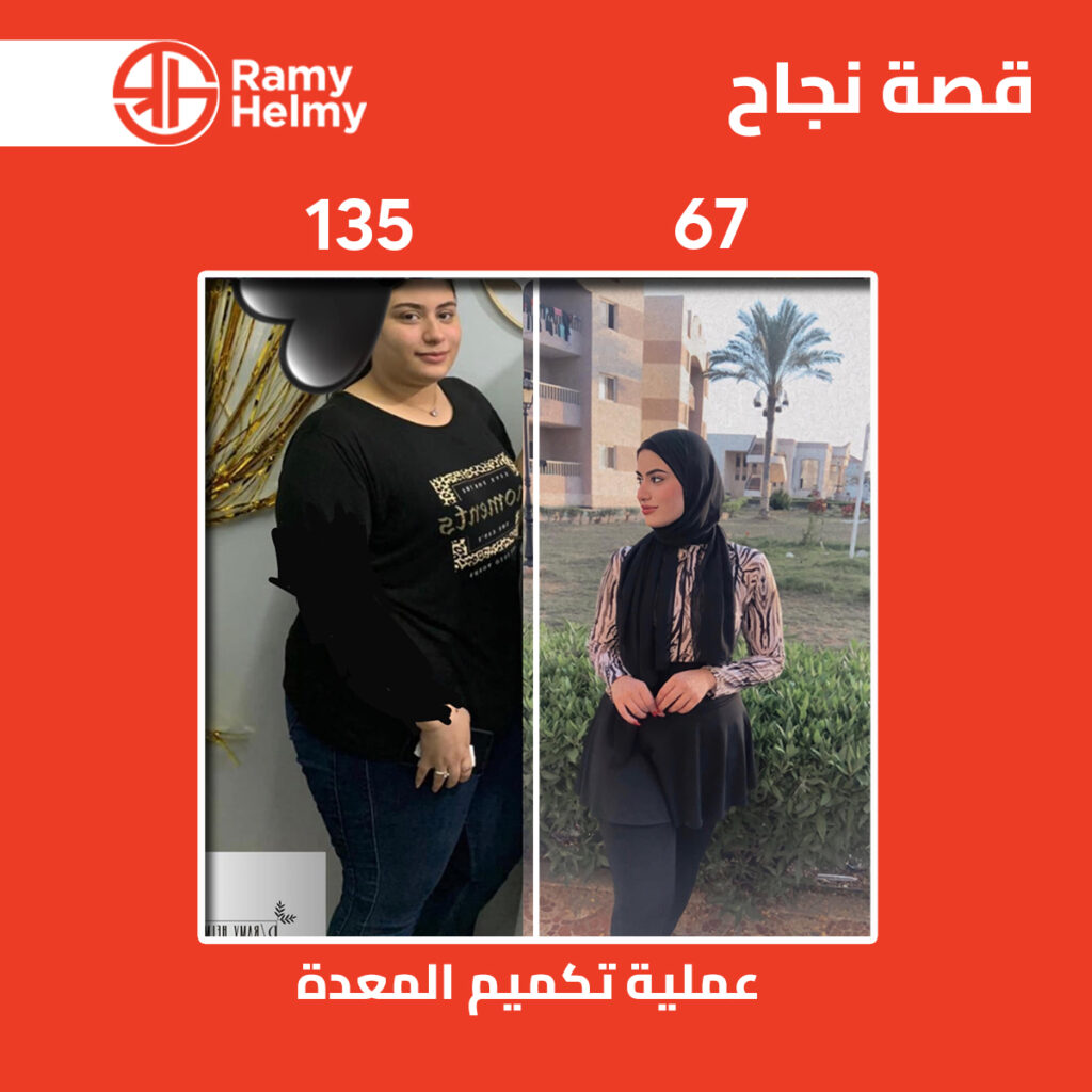 من نتائج عملية تكميم المعدة مع دكتور رامي حلمي