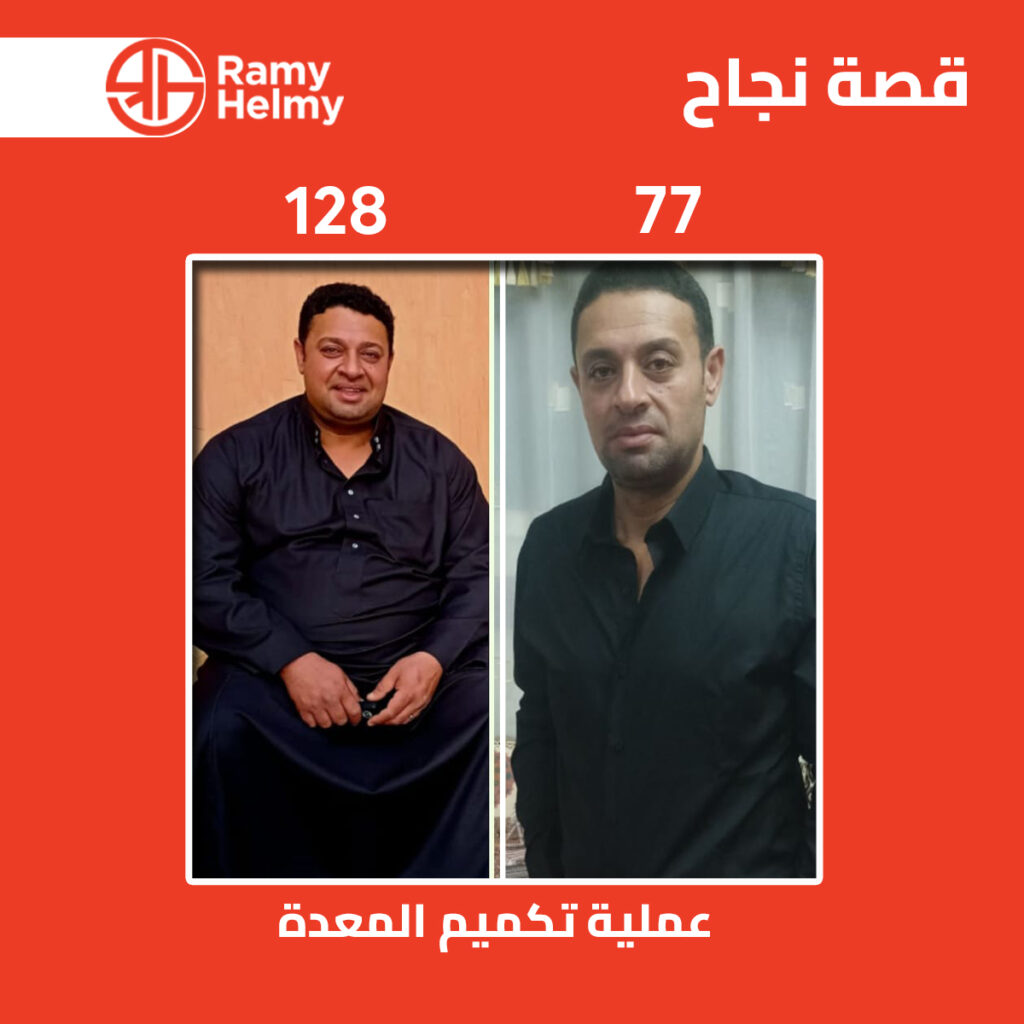 نتائج عملية تكميم المعدة مع دكتو رامي حلمي