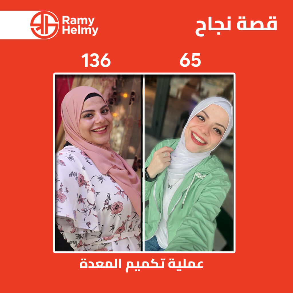 من نتائج تكميم المعدة مع الدكتور رامي حلمي