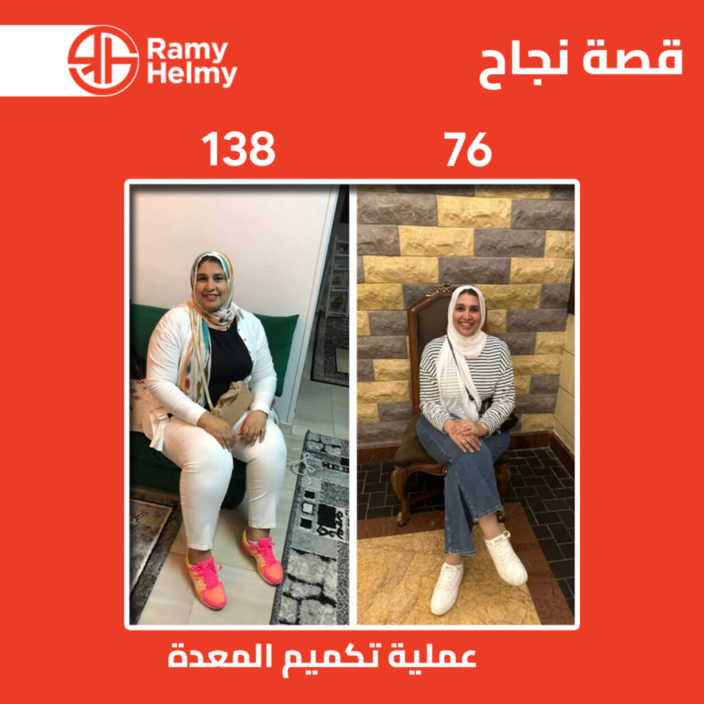 عملية تكميم المعدة