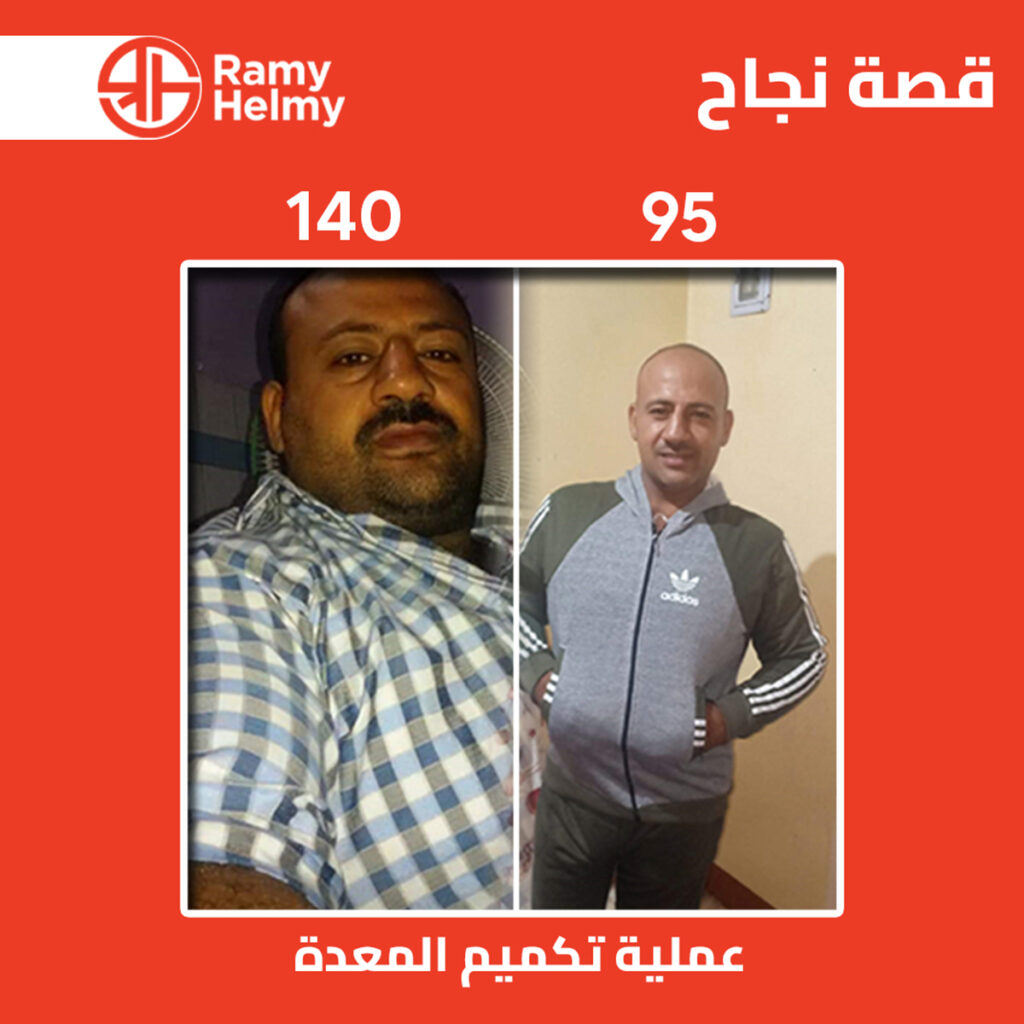 من نتائج عملية تكميم المعدة