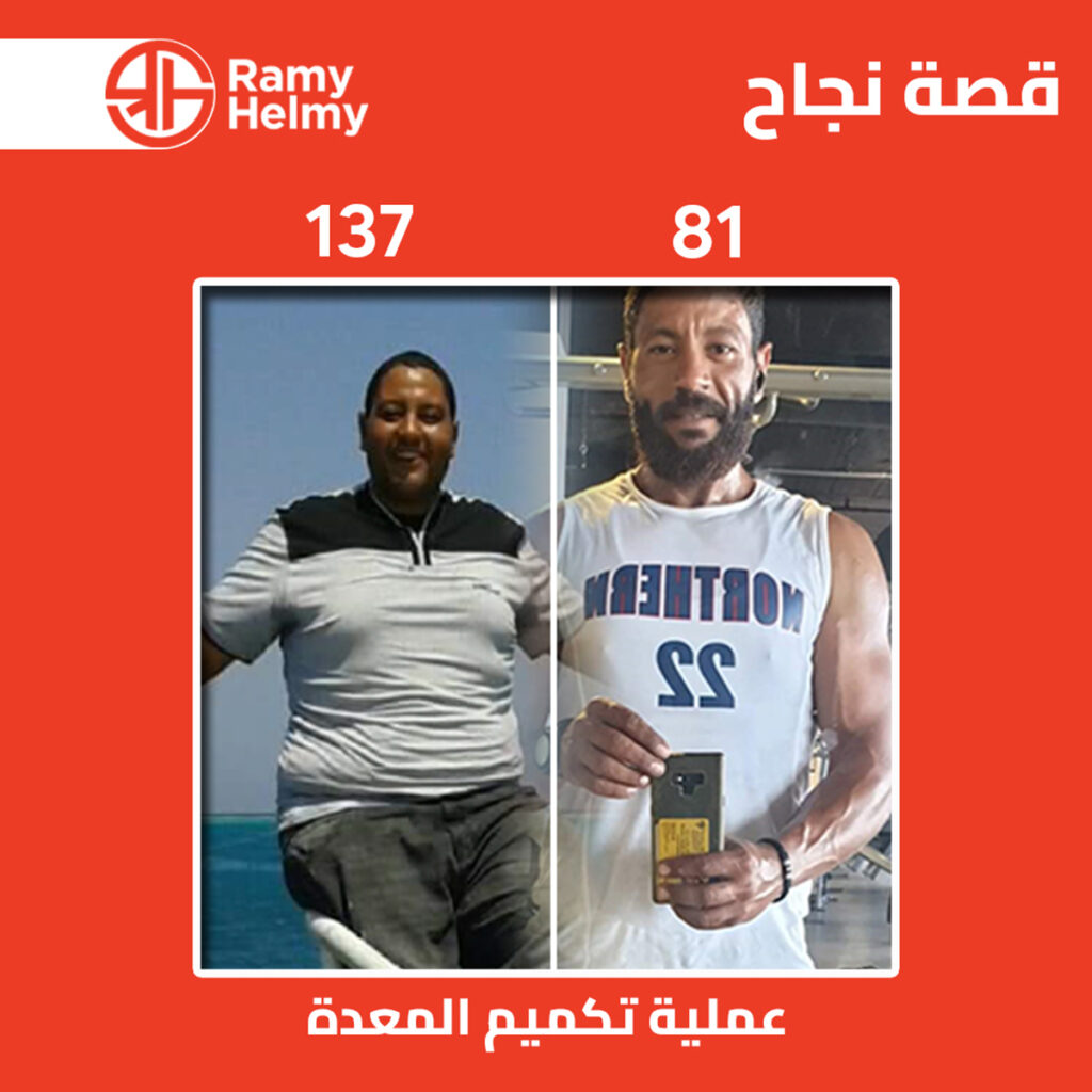 الأسئلة الشائعة حول عملية تكميم المعدة