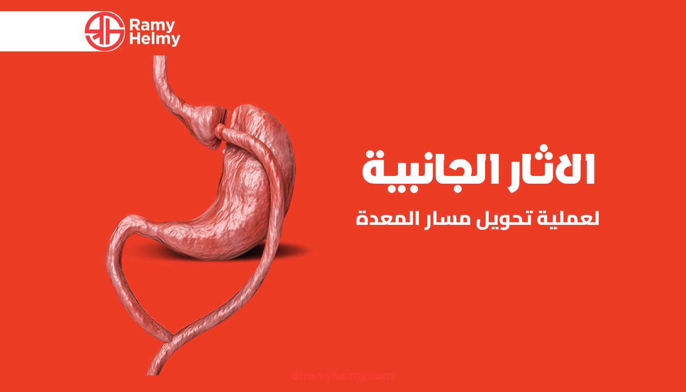 الاثار الجانبية لعملية تحويل مسار المعدة
