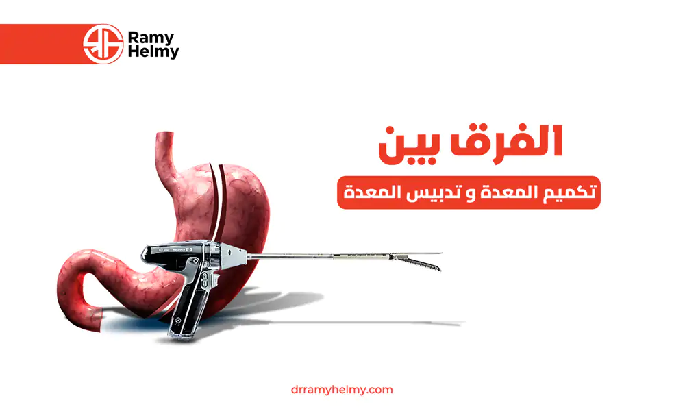 الفرق بين تكميم المعدة وتدبيس المعدة
