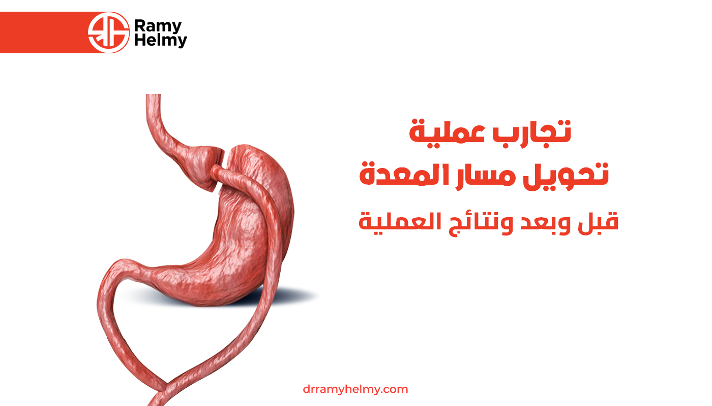 تجارب عملية تحويل مسار المعدة