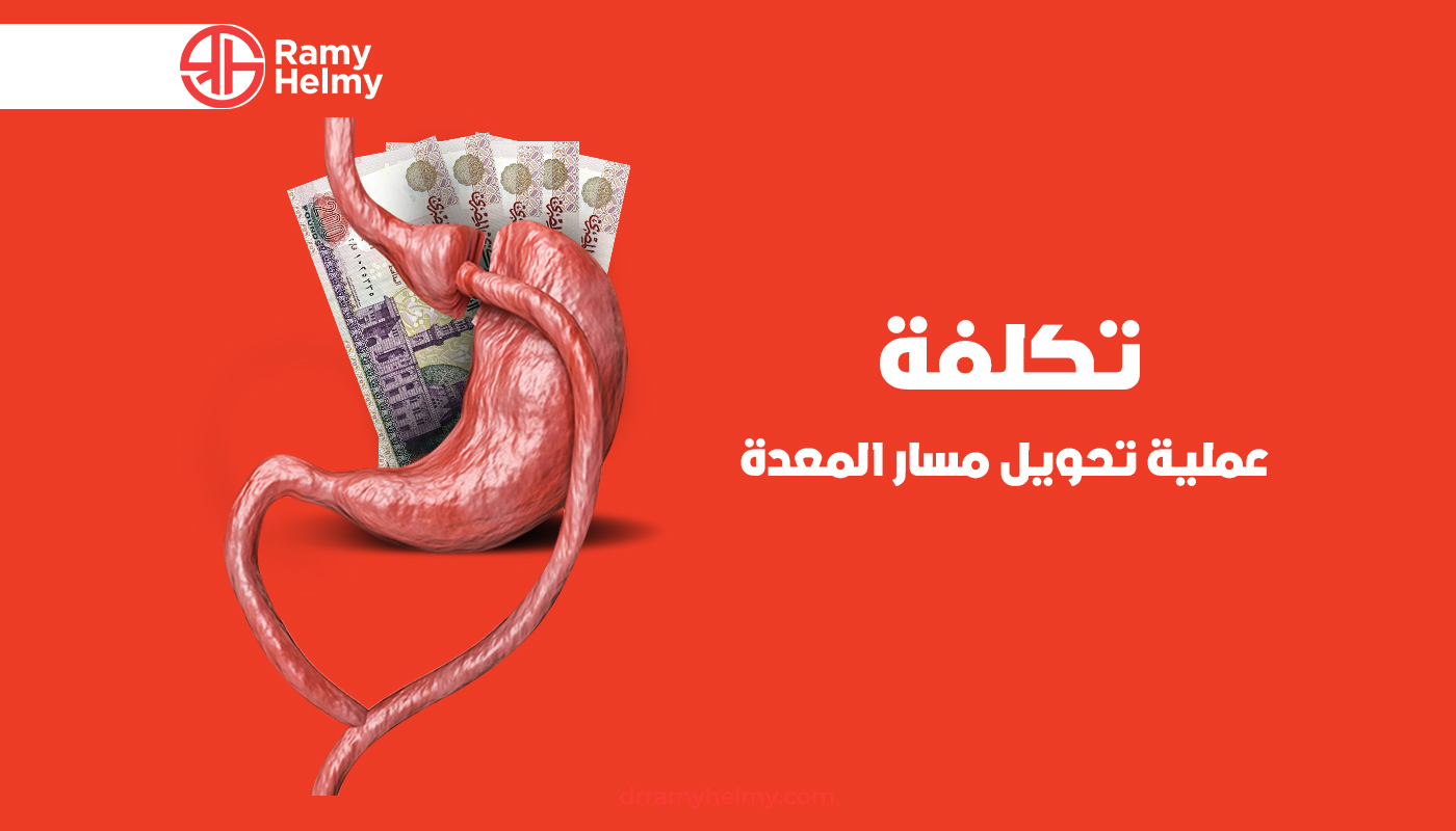 تكلفة عملية تحويل مسار المعدة