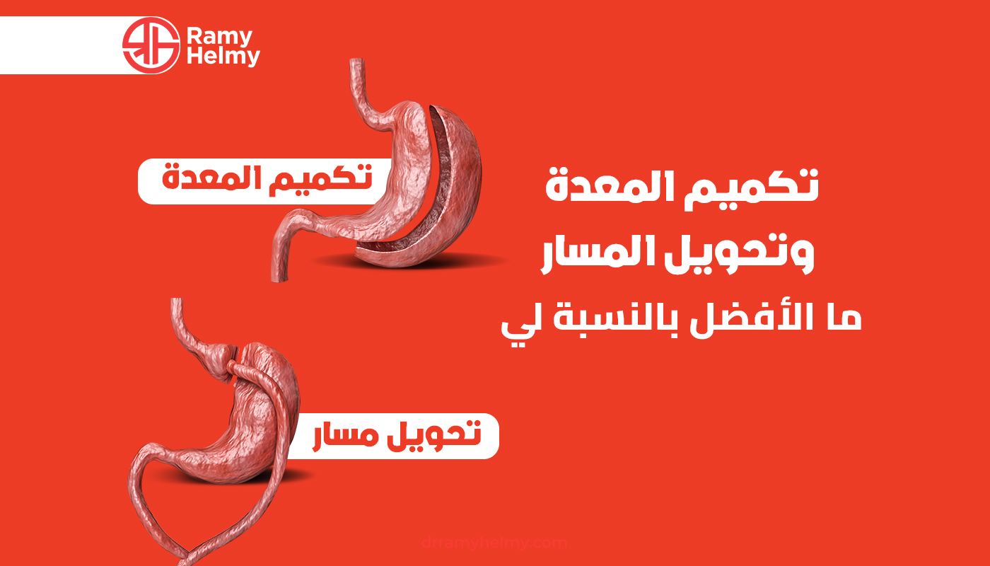 تكميم المعدة وتحويل المسار