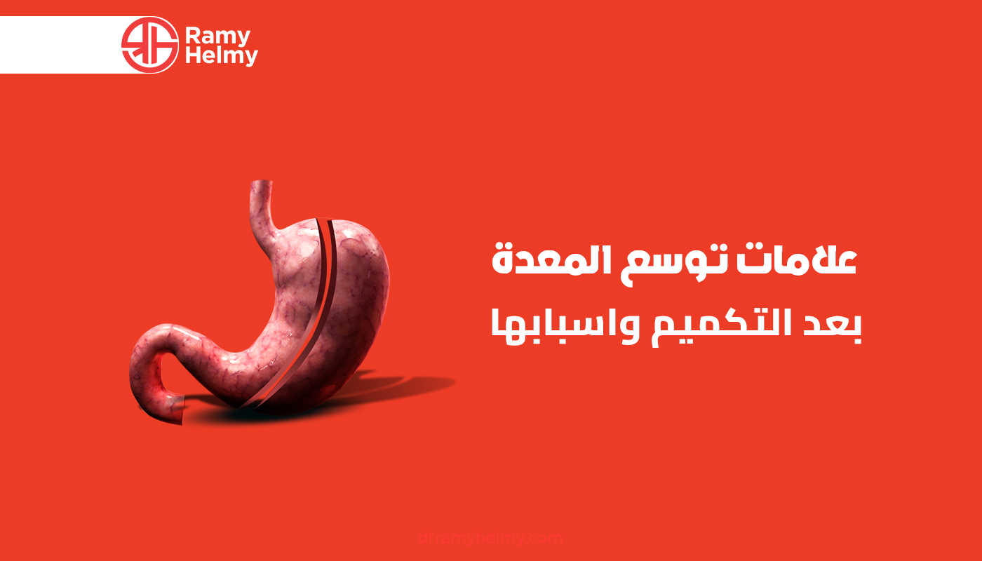 علامات توسع المعدة بعد التكميم