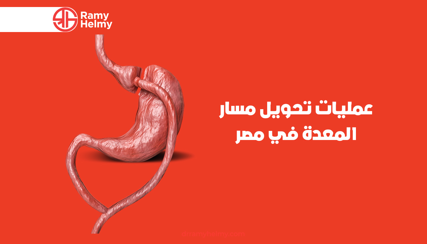 عمليات تحويل مسار المعدة في مصر