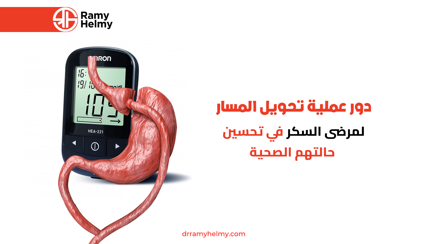 عملية تحويل المسار لمرضى السكر