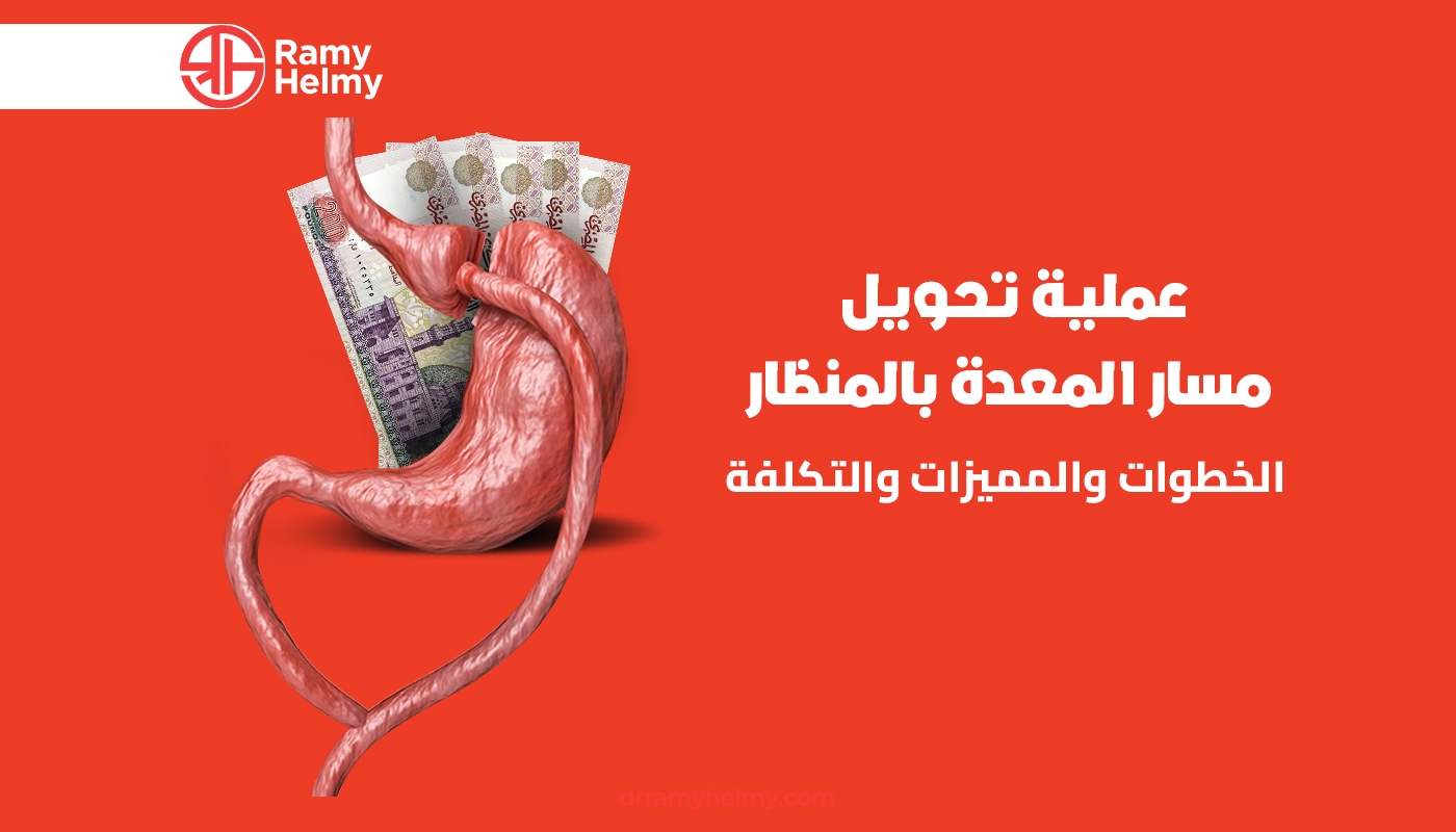 عملية تغيير مسار المعدة بالمنظار