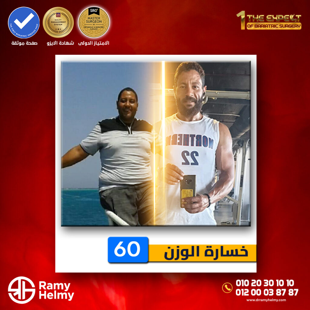 من نتائج تكميم المعدة في عيادة دكتور رامي حلمي