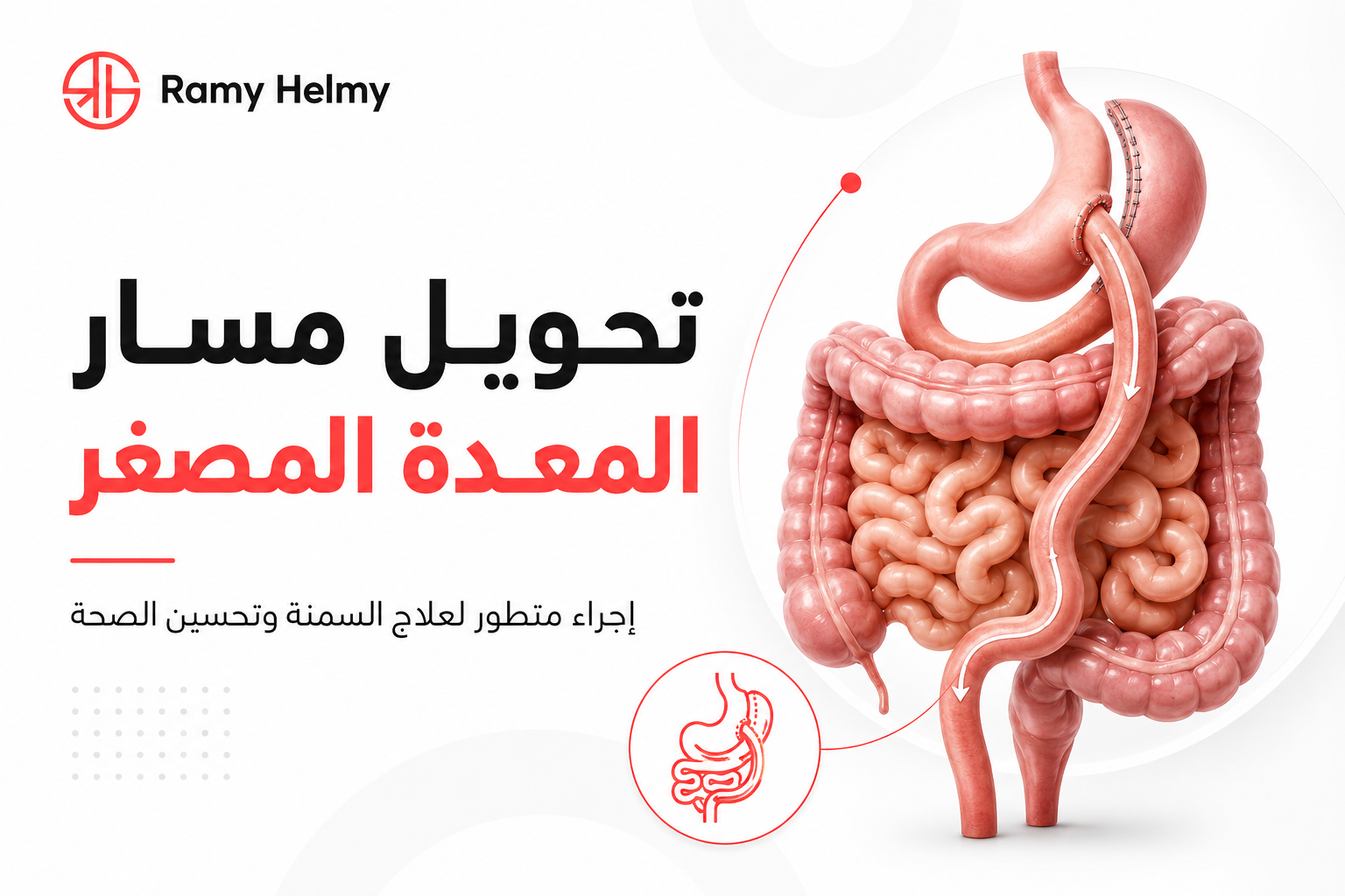 عملية تحويل مسار المعدة المصغر