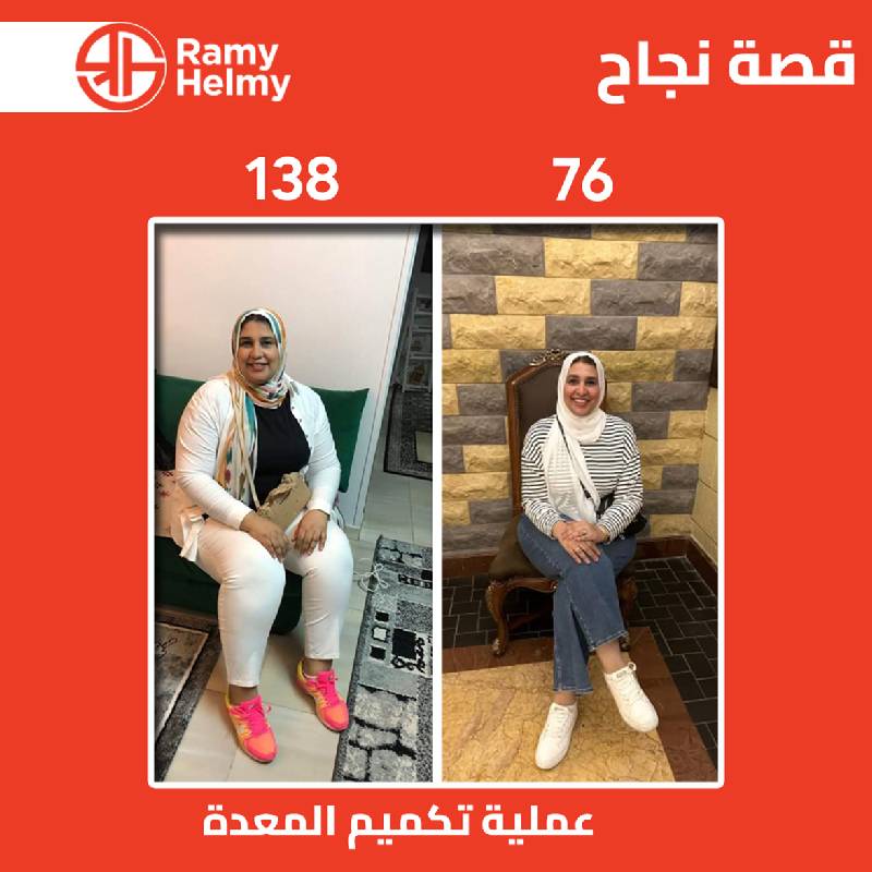 عملية تكميم المعدة بالمنظار 