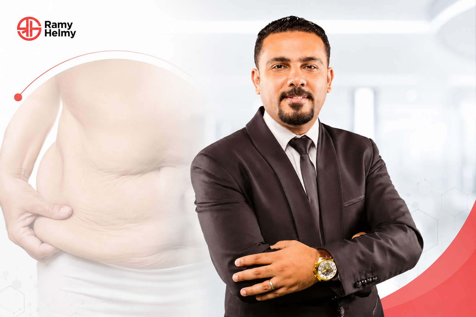 الجلد الزائد بعد عملية تكميم المعدة